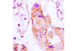 Immunohistochemical analysis of AIM2 staining in human lung cancer formalin fixed paraffin embedded tissue section. (AIM2 Antikörper  (Center))