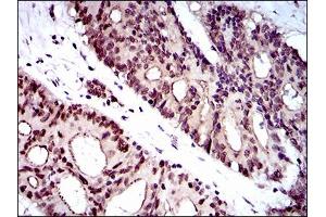 Immunohistochemical analysis of paraffin-embedded colon cancer tissues using WHSC2 mouse mAb with DAB staining. (WHSC2 Antikörper  (AA 280-511))