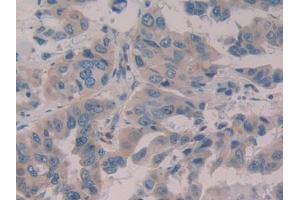 DAB staining on IHC-P; Samples: Human Breast cancer Tissue (WISP1 Antikörper  (AA 216-347))