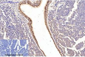 Immunohistochemical analysis of paraffin-embedded human lung cancer tissue. (Collagen Type I Antikörper)