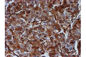Immunohistochemical staining of paraffin-embedded Carcinoma of Human liver tissue using anti-TUBB4 mouse monoclonal antibody. (TUBB4 Antikörper)