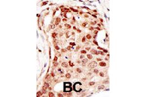 Formalin-fixed and paraffin-embedded human cancer tissue reacted with CBLC polyclonal antibody  , which was peroxidase-conjugated to the secondary antibody, followed by DAB staining. (CBLC Antikörper  (C-Term))