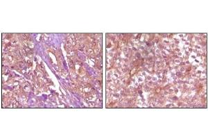 Immunohistochemical analysis of paraffin-embedded Human pancreas carcinoma (left) and breast carcinoma (right) tissue, showing membrane and cytoplasmic (pancreas carcinoma) localization, membrane (breast carcinoma) localization using EphB4 antibody with DAB staining. (EPH Receptor B4 Antikörper)