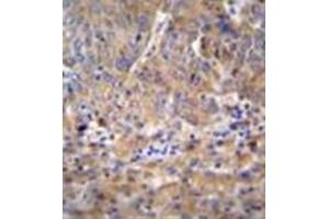 Formalin fixed and paraffin embedded human hepatocarcinoma reacted with DEF Antibody (N-term) followed by peroxidase conjugation of the secondary antibody and DAB staining (C11ORF58 Antikörper  (N-Term))