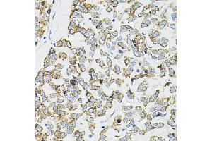 Immunohistochemistry of paraffin-embedded human esophageal cancer using PPP1CA antibody. (PPP1CA Antikörper)