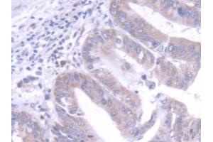 DAB staining on IHC-P; Samples: Human Liver cancer Tissue (FGF20 Antikörper  (AA 1-211))