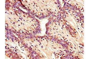 Immunohistochemistry of paraffin-embedded human breast cancer using  at dilution of 1:100 (CDKN2A Antikörper  (AA 1-86))