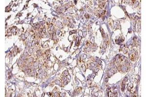 ABIN6275243 at 1/100 staining Human breast cancer tissue by IHC-P. (MRPL39 Antikörper  (C-Term))