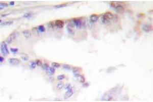 Immunohistochemistry (IHC) analyzes of CREB-1 antibody in paraffin-embedded human lung carcinoma tissue. (CREB1 Antikörper)