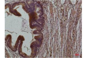 Immunohistochemistry (IHC) analysis of paraffin-embedded Human Colon Carcinoma using STAT3 Mouse Monoclonal Antibody diluted at 1:200. (STAT3 Antikörper)
