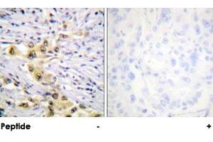 Immunohistochemical analysis of paraffin-embedded human lung carcinoma tissue using IGF2R polyclonal antibody .
