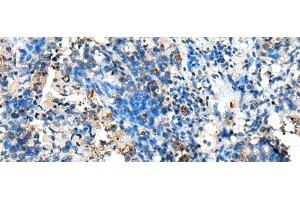 Immunohistochemistry of paraffin-embedded Human lung cancer tissue using NUDT10 Polyclonal Antibody at dilution of 1:70(x200) (NUDT10 Antikörper)