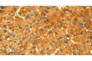 Immunohistochemistry of paraffin-embedded Human liver cancer tissue using GK1 Polyclonal Antibody at dilution 1:60