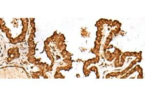 Immunohistochemistry of paraffin-embedded Human thyroid cancer tissue using FAM200A Polyclonal Antibody at dilution of 1:55(x200) (FAM200A Antikörper)