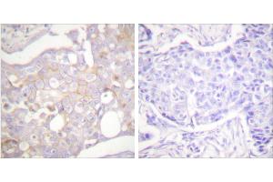 Peptide - +Immunohistochemical analysis of paraffin-embedded human breast carcinoma tissue using Claudin 4 antibody (#C0141). (Claudin 4 Antikörper)