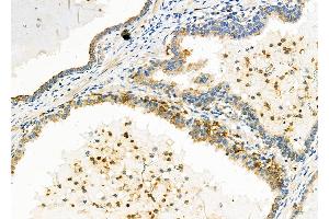 ABIN6257891 and ABIN6273815 at 1/100 staining Human prostate cancer by IHC-P. (TRIO Antikörper  (Internal Region))