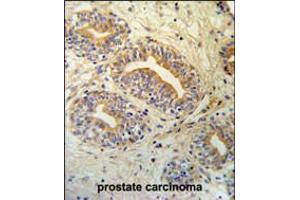 CWC15 Antibody IHC analysis in formalin fixed and paraffin embedded prostate carcinoma followed by peroxidase conjugation of the secondary antibody and DAB staining. (CWC15 Antikörper  (AA 123-152))