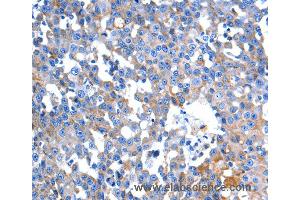 Immunohistochemistry of Human colon cancer using HINT2 Polyclonal Antibody at dilution of 1:60 (HINT2 Antikörper)