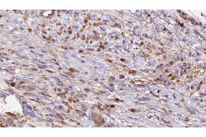ABIN6272697 at 1/100 staining Human liver cancer tissue by IHC-P. (GRM2 Antikörper  (Internal Region))