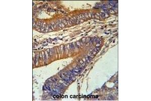 KLC3 Antibody (Center) (ABIN651542 and ABIN2840291) immunohistochemistry analysis in formalin fixed and paraffin embedded human colon carcinoma followed by peroxidase conjugation of the secondary antibody and DAB staining. (KLC3 Antikörper  (AA 245-274))