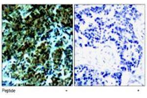 Immunohistochemical analysis of paraffin-embedded human breast carcinoma tissue, using Ctdp1 polyclonal antibody .