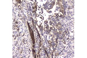 IHC testing of FFPE human colon cancer tissue with LC3A antibody at 1ug/ml. (MAP1LC3A Antikörper)