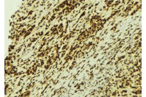ABIN6274154 at 1/100 staining Human breast cancer tissue by IHC-P. (HNRNPC Antikörper  (C-Term))