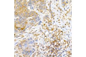 Immunohistochemistry of paraffin-embedded human esophageal cancer using CLIC4 Rabbit pAb (ABIN6127638, ABIN6138723, ABIN6138724 and ABIN6222890) at dilution of 1:50 (40x lens). (CLIC4 Antikörper  (AA 1-253))