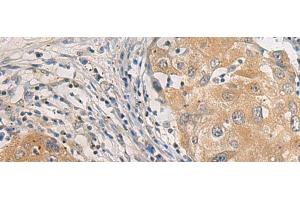 Immunohistochemistry (Paraffin-embedded Sections) (IHC (p)) image for anti-ArfGAP with GTPase Domain, Ankyrin Repeat and PH Domain 3 (AGAP3) antibody (ABIN7248431)