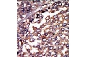 Formalin-fixed and paraffin-embedded human cancer tissue reacted with the primary antibody, which was peroxidase-conjugated to the secondary antibody, followed by AEC staining. (PRKACA Antikörper  (N-Term, Regulatory Subunit 1))