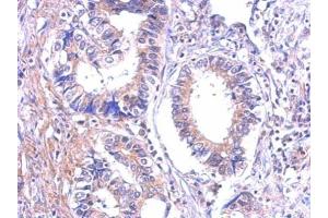 IHC-P Image Immunohistochemical analysis of paraffin-embedded human gastric cancer, using P2Y7, antibody at 1:500 dilution. (Leukotriene B4 Receptor/BLT Antikörper)