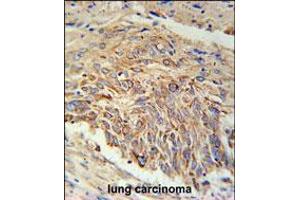 EBPL Antibody immunohistochemistry analysis in formalin fixed and paraffin embedded human lung carcinoma followed by peroxidase conjugation of the secondary antibody and DAB staining. (EBPL Antikörper  (C-Term))