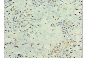 Immunohistochemistry of paraffin-embedded human breast cancer using ABIN7156607 at dilution of 1:100 (IL29 Antikörper  (AA 20-200))