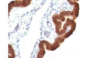 Formalin-fixed, paraffin-embedded human ovarian carcinoma stained with Cytokeratin 19 antibody (KRT19/799 + KRT19/800) (Cytokeratin 19 Antikörper)