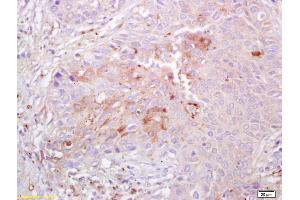 Formalin-fixed and paraffin embedded human lung carcinoma labeled with Anti Integrin alpha 3 Polyclonal Antibody , Unconjugated at 1:200, followed by conjugation to the secondary antibody and DAB staining (ITGA3 Antikörper  (AA 976-1025))