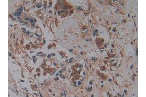 DAB staining on IHC-P; Samples: Human Breast cancer Tissue (GMFG Antikörper  (AA 6-126))
