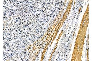 ABIN6263078 and ABIN6278934 at 1/100 staining human prostate cancer by IHC-P.