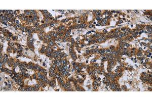 Immunohistochemistry of paraffin-embedded Human liver cancer tissue using LGALS2 Polyclonal Antibody at dilution 1:30 (Galectin 2 Antikörper)