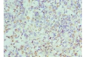 Immunohistochemistry of paraffin-embedded human endometrial cancer using ABIN7155102 at dilution of 1:100 (HNRNPD/AUF1 Antikörper  (AA 1-306))