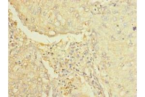 Immunohistochemistry of paraffin-embedded human lung cancer using ABIN7143633 at dilution of 1:100 (AARSD1 Antikörper  (AA 1-230))