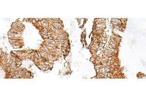 Immunohistochemistry of paraffin-embedded Human colorectal cancer tissue using GPR119 Polyclonal Antibody at dilution of 1:45(x200) (G Protein-Coupled Receptor 119 Antikörper)