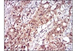 Immunohistochemical analysis of paraffin-embedded human cervical cancer tissues using RELB mouse mAb with DAB staining. (RELB Antikörper  (AA 273-443))
