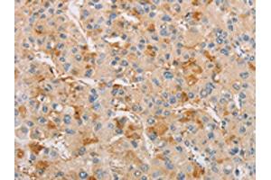The image on the left is immunohistochemistry of paraffin-embedded Human liver cancer tissue using ABIN7128532(ARSF Antibody) at dilution 1/20, on the right is treated with fusion protein. (ARSF Antikörper)