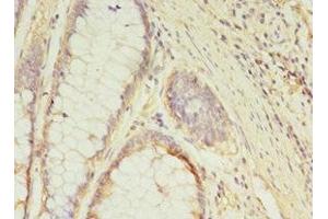 Immunohistochemistry of paraffin-embedded human colon cancer using ABIN7154452 at dilution of 1:100 (GCC1 Antikörper  (AA 4-775))