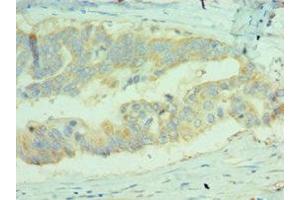 Immunohistochemistry of paraffin-embedded human colon cancer using ABIN7159680 at dilution of 1:100 (MICA Antikörper  (AA 24-307))
