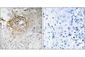 Immunohistochemistry analysis of paraffin-embedded human lung carcinoma tissue, using SCN9A Antibody. (SCN9A Antikörper  (AA 651-700))