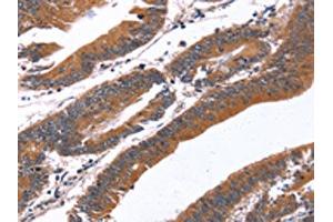 The image on the left is immunohistochemistry of paraffin-embedded Human colon cancer tissue using ABIN7190865(GREB1 Antibody) at dilution 1/40, on the right is treated with synthetic peptide. (GREB1 Antikörper)