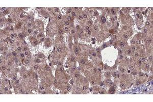 ABIN6277461 at 1/100 staining Human liver cancer tissue by IHC-P. (SSTR2 Antikörper  (C-Term))