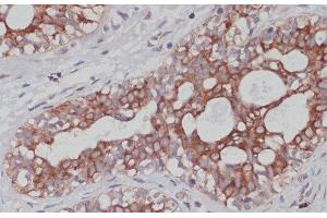 Immunohistochemistry of paraffin-embedded Human mammary cancer using TPD52 Polyclonal Antibody at dilution of 1:100 (40x lens). (TPD52 Antikörper)