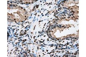 Immunohistochemical staining of paraffin-embedded Adenocarcinoma of ovary tissue N93ing anti-BSG mouse monoclonal antibody. (CD147 Antikörper)